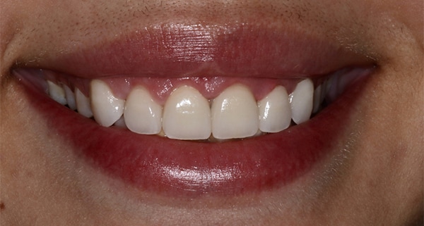 porcelain veneers after