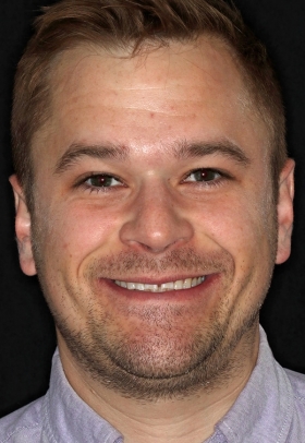 Porcelain Veneers Before