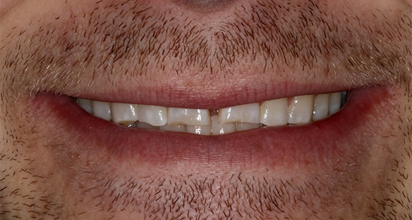 porcelain veneers before