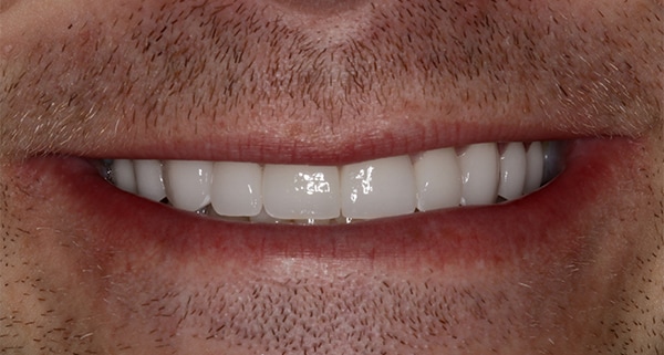 porcelain veneers after