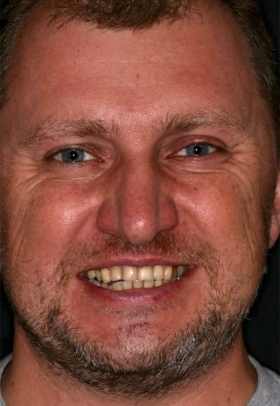 Porcelain Veneers Before