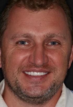 Porcelain Veneers After