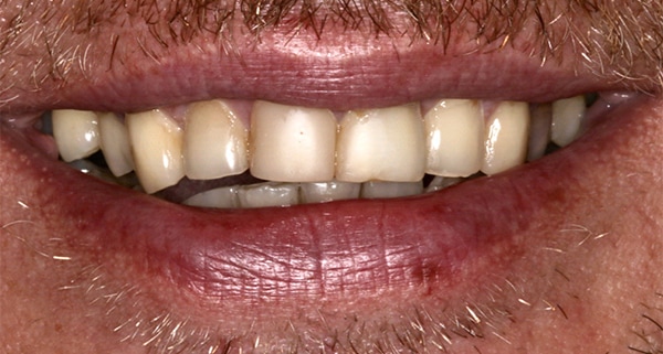 porcelain veneers before