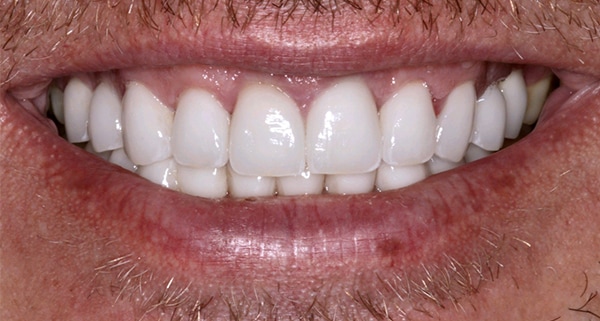 porcelain veneers after