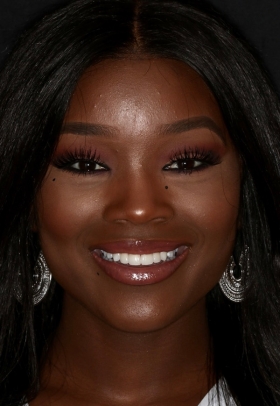 Porcelain Veneers After