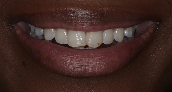 porcelain veneers before