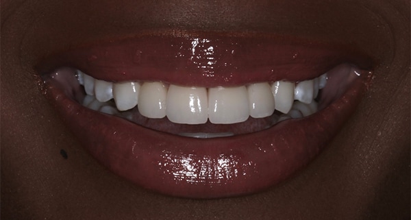 porcelain veneers after