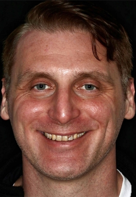 Porcelain Veneers Before