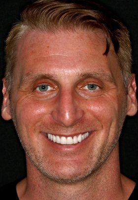 Porcelain Veneers After