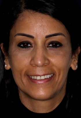 Porcelain Veneers Before