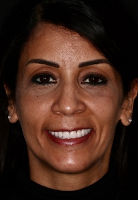 Porcelain Veneers After