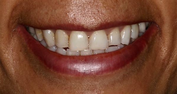 porcelain veneers before