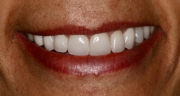 porcelain veneers after