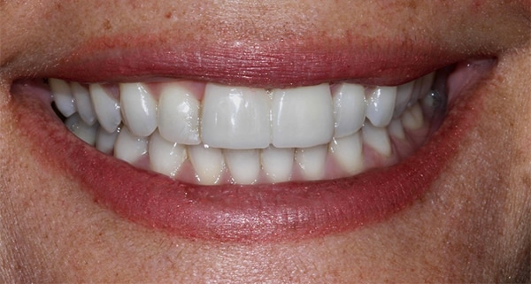 porcelain veneers before