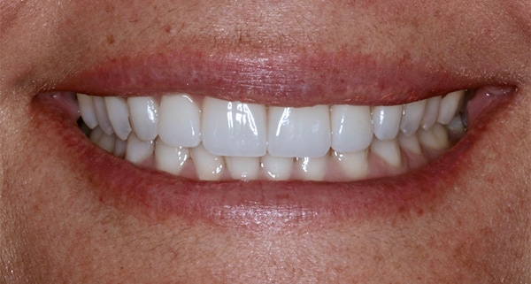 porcelain veneers after