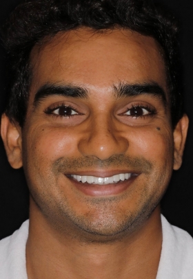 Porcelain Veneers After