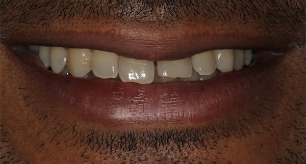 porcelain veneers before