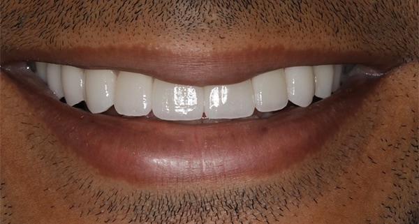 porcelain veneers after