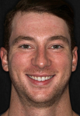 Porcelain Veneers Before