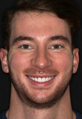 Porcelain Veneers After