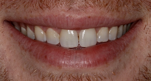 porcelain veneers before