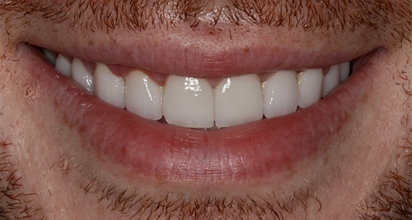 porcelain veneers after