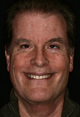 Porcelain Veneers Before