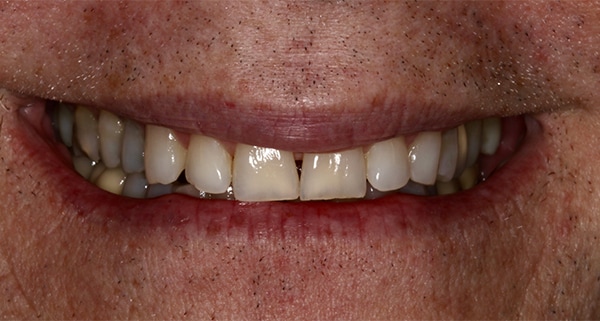 porcelain veneers before