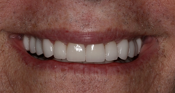 porcelain veneers after