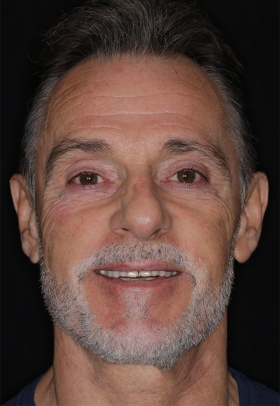 Porcelain Veneers Before