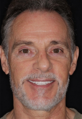 Porcelain Veneers After