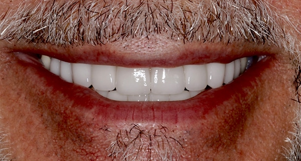 porcelain veneers after