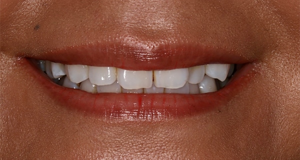 porcelain veneers before