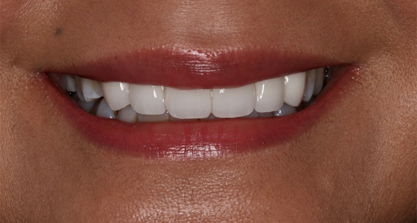 porcelain veneers after