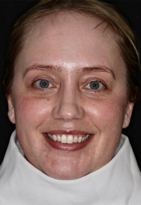 Porcelain Veneers Before