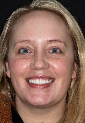 Porcelain Veneers After