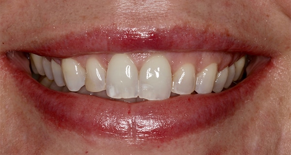 porcelain veneers before