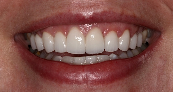 porcelain veneers after