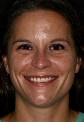 Porcelain Veneers Before