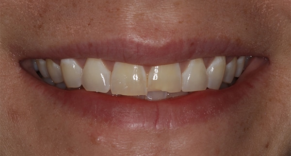 porcelain veneers before