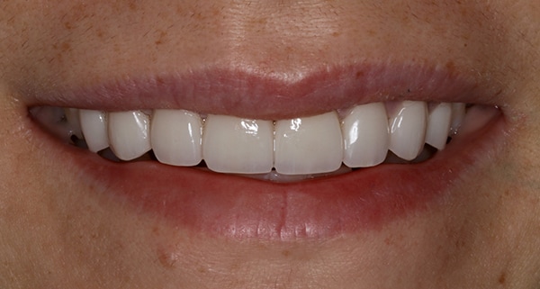 porcelain veneers after