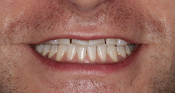 porcelain veneers before