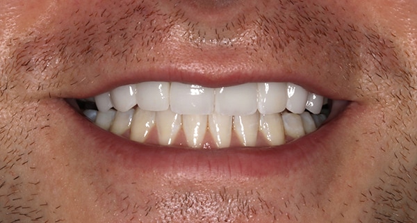 porcelain veneers after