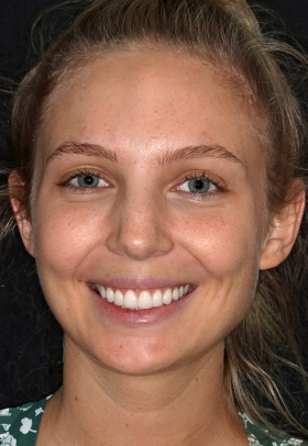 Porcelain Veneers After