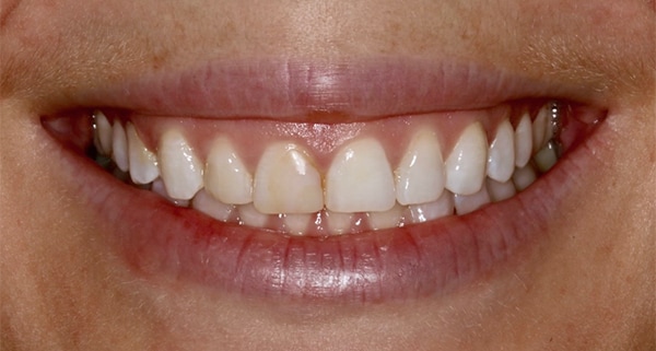 porcelain veneers before