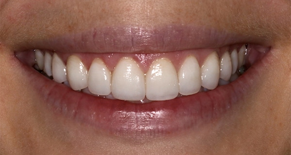 porcelain veneers after