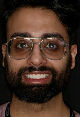 Porcelain Veneers After