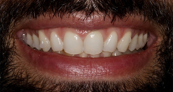 Porcelain Veneers Photos NYC - Smile Before Men Patient 55