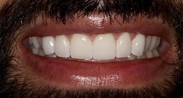 porcelain veneers after