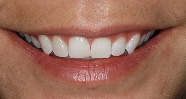 porcelain veneers before